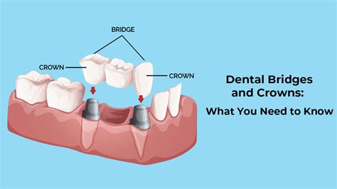 crown & ivy|what is dental crowns.